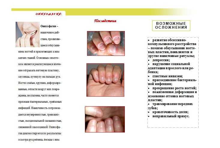 Онихофагия, привычка грызть ногти. причины, лечение, советы