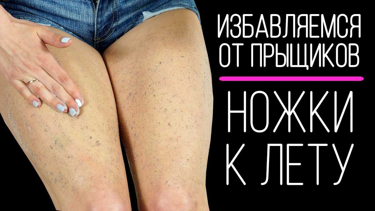 Как избавиться от прыщей на попе быстро, за 1 день. причины и лечение у женщин в домашних условиях