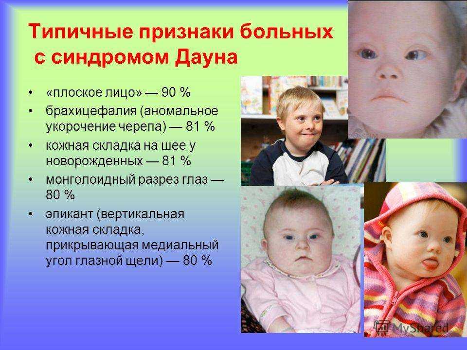 Дети с синдромом дауна | без соски - здоровое развитие ребенка