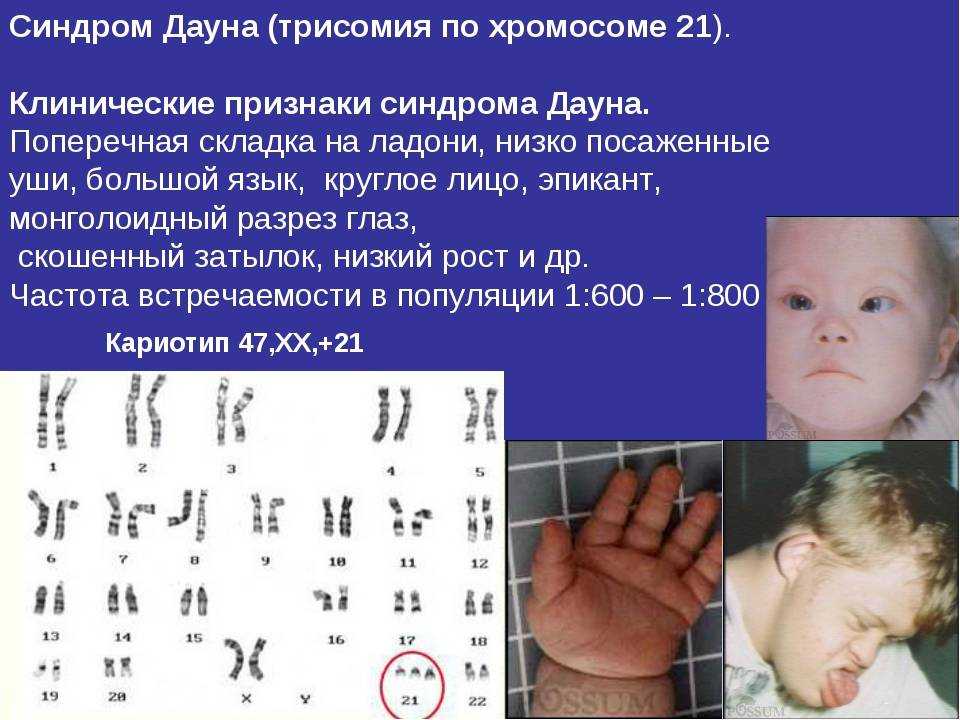 Синдром дауна: факты и ответы на вопросы
